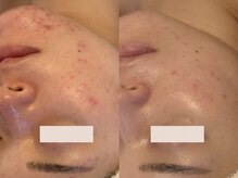 アン(An)/ニキビケア