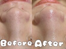 グラシア 倉敷店(Gracia)/ハイドラ毛穴洗浄