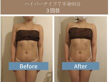 漢方アロマヒーリングサロン 浦和店(漢方AROMAヒーリングサロン)/ハイパーナイフ７半身◇3回目◇