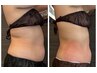 【5kg痩せ見え痩身】脂肪冷却2カップ★モニター限定 通常22000円→9900円