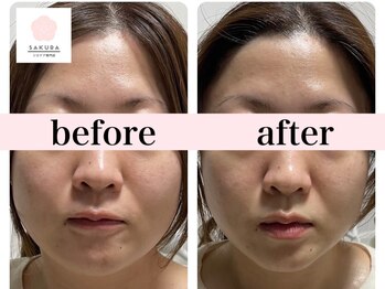 サクラ(SAKURA)/30代小顔の特化したエアバリ◎