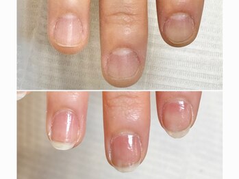 グラシュータン(gracieux temps)/深爪矯正