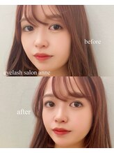 アン(anne)/before・after