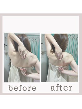 アリサナ(Arisana)/症例写真　肩甲骨はがし