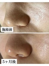 ルオント(LUONTO)/開き毛穴もケアすれば引き締まる