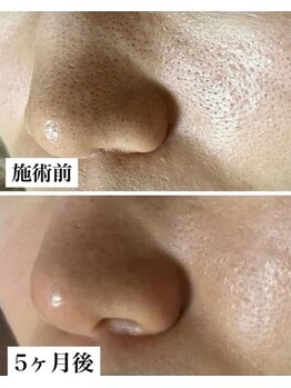 ルオント(LUONTO)/開き毛穴もケアすれば引き締まる