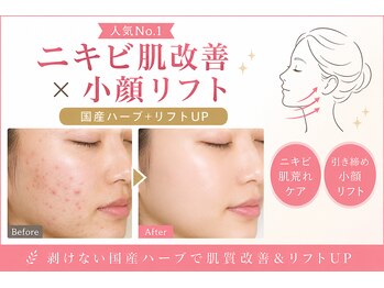 レフアの写真/《美肌&小顔》剥離なし国産ハーブピーリング×リフトマシンで透明感UP&輪郭シュッ!諦めていたお悩みに♪