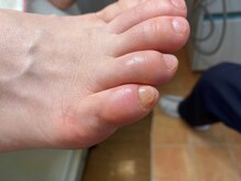 フットメンテ 巻き爪矯正センター 南浦和/副爪　施術後