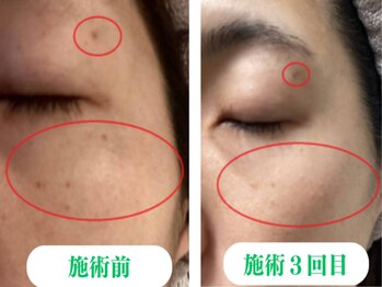ヒトハダ(hitohada)/30代女性 《シミケア3回》