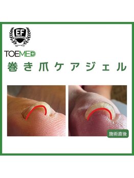 【フット】巻爪矯正 TOEMED
