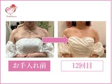 ディア スプリーマ/ブライダルエステ計14回