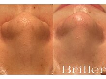 ブリエ(Briller)/毛穴洗浄＋鎮静パック
