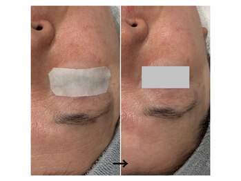 サロン テン(salon TEN)/おでこのシワやたるみに