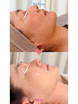 エテル(eter)/40代女性水光ピール3回目