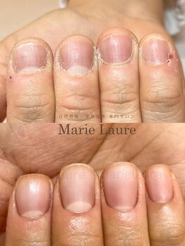 マリーロール 梅田店(Marie Laure)/自爪育成/深爪矯正/ネイルケア