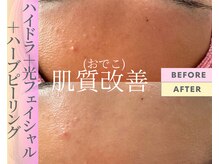 Cスキンケアクリニック 麻布店/ハイドラ+光フェイシャル+ハーブ