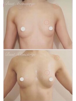 美人バスト 本厚木店/バストアップ◇症例◇