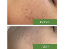 ミミー/ハーブピーリング/ニキビケア