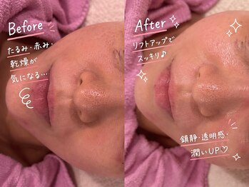 ケイ(K)/防府　エステ　リフトアップ