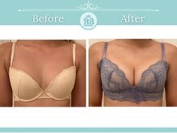 ベルビューティー(belle beauty)/【サイズアップ/C以下】症例写真