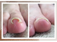 ルポ(REPOS)/巻き爪ケア