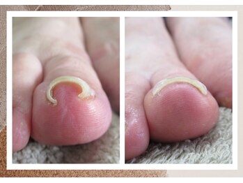 ルポ(REPOS)/巻き爪ケア