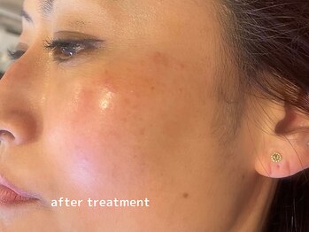 オアシスラグーン(OASIS LAGOON)/シミケア(症例2:after)