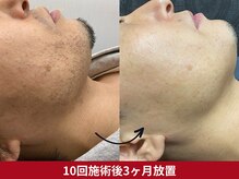 美容脱毛専門サロン エピラージュ 新宿店(Epilage)/メンズヒゲ脱毛