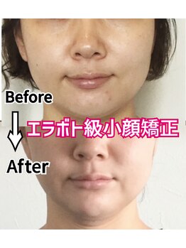 アコルデ 岡山問屋町(ACORDE)/小顔矯正ver.5