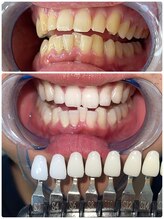 エクシアホワイトニング 札幌中島公園店/Before After［ホワイトニング］