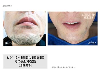 フェレザ 新潟(Felleza)/剃刀負けに悩む男性必見