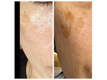 ココスタイルビューティー(COCOSTYLE beauty)の雰囲気（ララピールコースとシミ改善を交互に施術）