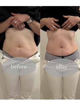 マホロバ セカンド(mahoroba 2nd)/EMSプラス腸活マッサージ