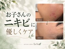 レア(Le'a)の雰囲気（お子さんの思春期ニキビもお任せください♪学割クーポンあります）