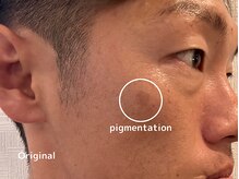 オアシスラグーン(OASIS LAGOON)/シミケア（症例３：before）