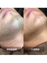 リムル(REMURU)/ひげ脱毛11回照射