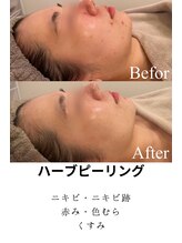 ベクラ 名古屋店(Becla)&nbsp;ハーブ 施術工程