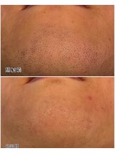 メンズサロン エイチ(H)/効果◎