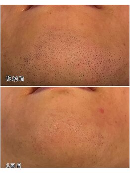 メンズサロン エイチ(H)/効果◎