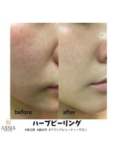 アクシア ビューティー サロン(AXSIA)/【ハーブピーリング】
