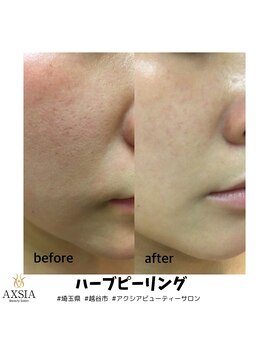 アクシア ビューティー サロン(AXSIA)/【ハーブピーリング】
