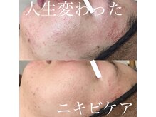 エクレクティック(ECLECTIC)/肌質改善/大人ニキビケア/美肌