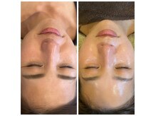 久留米市初導入！ラミネーションピール