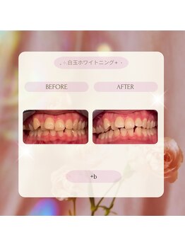 プラスビー 2号店(+b)/ホワイトニングビフォーアフター