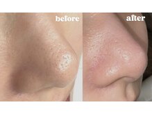 ピンキー 中野(pinky)の雰囲気（【超音波クレンジング】小鼻の黒ずみや毛穴におすすめ！）