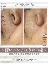 ピュアル 川口(Pual)/Pual症例【ほうれい線】70代