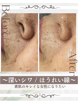 ピュアル 川口(Pual)/Pual症例【ほうれい線】70代