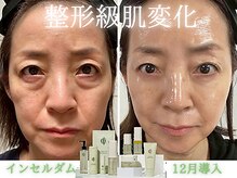 札幌インセルダム/整形級ツヤ肌スキンケア/たるみ/リフトアップ