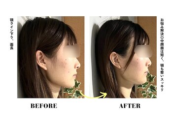 コアサロン(58SALON)の写真/【劇的効果で大人気】小顔矯正♪当店人気No.1メニュー☆スッキリ小顔を目指すなら当店にお任せ下さい！