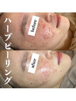 モンレーヴ(MonReve)/ハーブピーリング